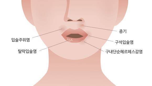 입 주위 질환별 위치. ⓒ 을지병원