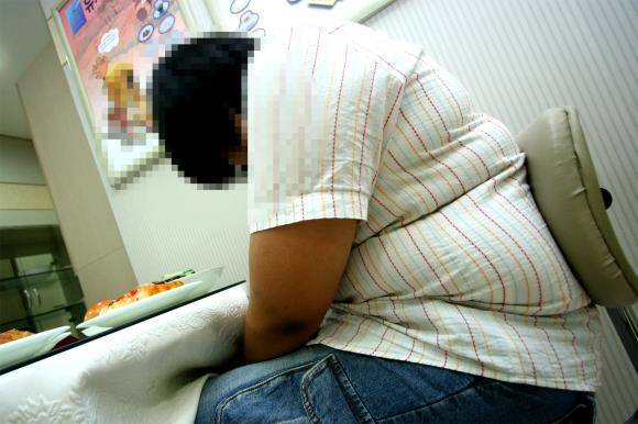 체질량지수 35 이상이거나 비만 합병증을 동반한 경우 비만수술 시 건강보험이 적용된다. ⓒ 서울백병원
