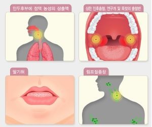 성홍열 증상. ⓒ 질병관리청 국가건강정보포털